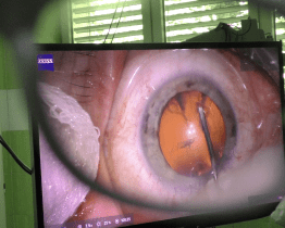 Oční oddělení dostane nový operační mikroskop